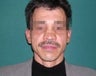 Rhinoplasty