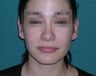 Rhinoplasty