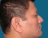 Nose Surgery