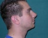 Rhinoplasty