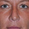 Rhinoplasty