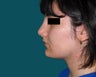 Rhinoplasty