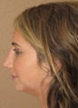 rhinoplasty