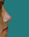 Rhinoplasty