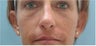 Rhinoplasty