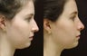 rhinoplasty