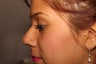 Rhinoplasty