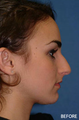 Rhinoplasty