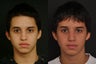 Rhinoplasty
