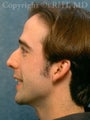 Rhinoplasty