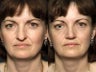 Nose Surgery