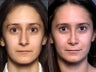Nose Surgery