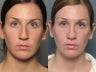 Nose Surgery