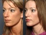 Nose Surgery