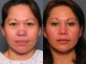 Nose Surgery