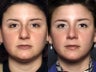 Nose Surgery