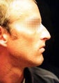 Nose Surgery