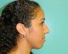 Nose Job- Rhinoplasty