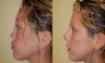 Revision Rhinoplasty Nose Surgery