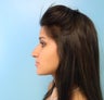 Rhinoplasty- Nose Job