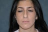 Rhinoplasty