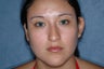 Rhinoplasty