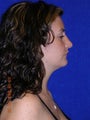 Rhinoplasty