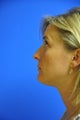 Nasal airway surgery with cosmetic improvment