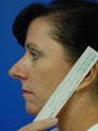 Nose Surgery/Rhinoplasty