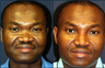 Nasal Dorsal Implant and Nostril Reduction