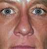 Rhinoplasty