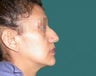 Rhinoplasty