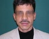 Rhinoplasty