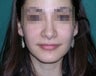 Rhinoplasty