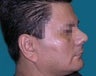 Nose Surgery