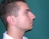 Rhinoplasty