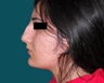 Rhinoplasty