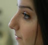 Rhinoplasty