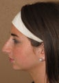 rhinoplasty