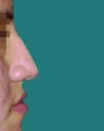 Rhinoplasty