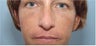 Rhinoplasty