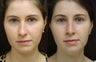 rhinoplasty
