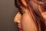 Rhinoplasty