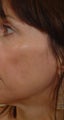 Pearl Laser Treatment