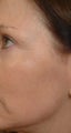 Pearl Laser Treatment