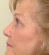 Pearl Laser Treatment