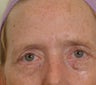 Pearl Laser Treatment