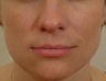 Pearl Laser Treatment