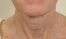 Pearl Laser Treatment