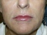 Getting great results with Pearl Fractional